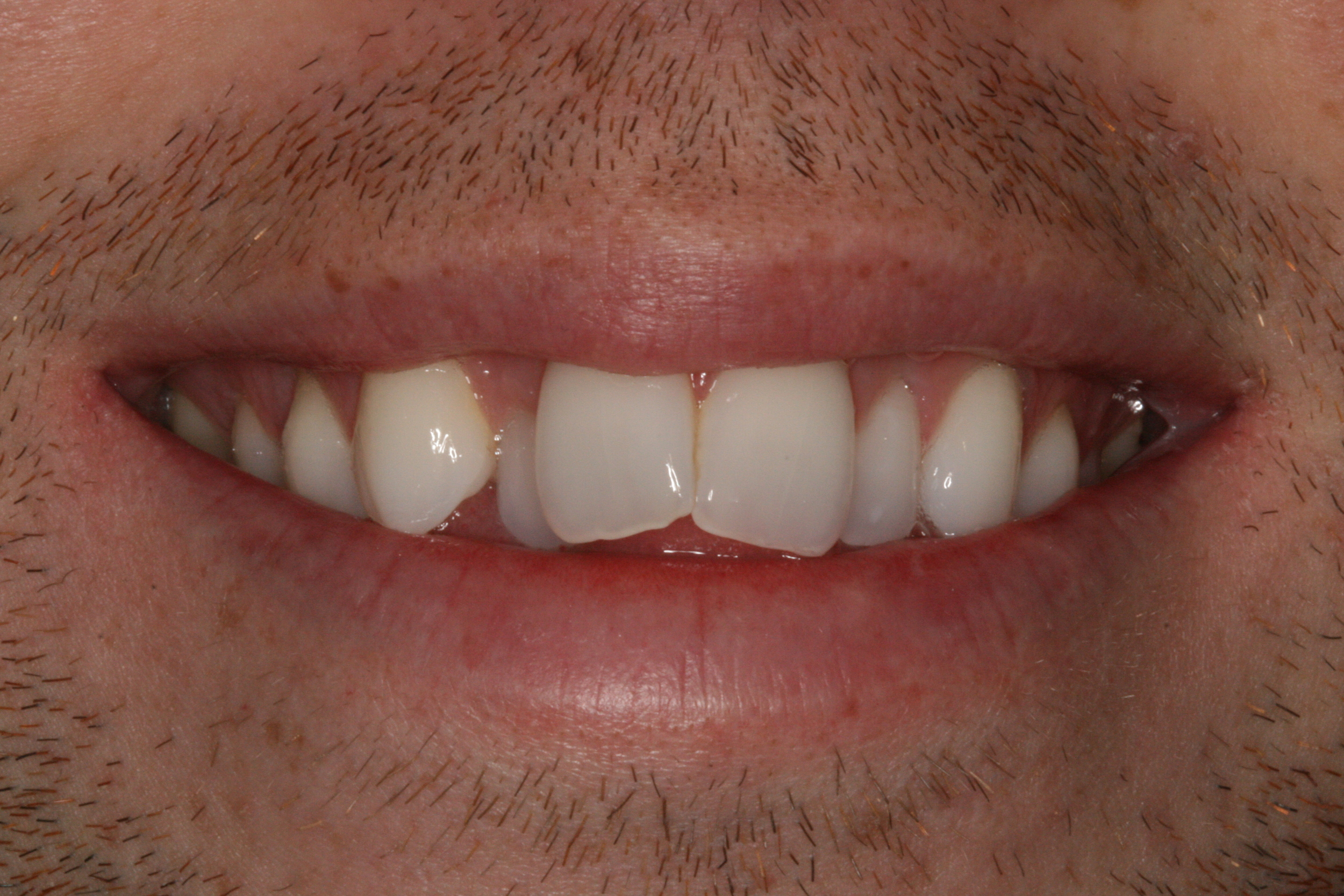 The Tuddenham Road Dental Surgery - Six_Month_Smiles5.JPG