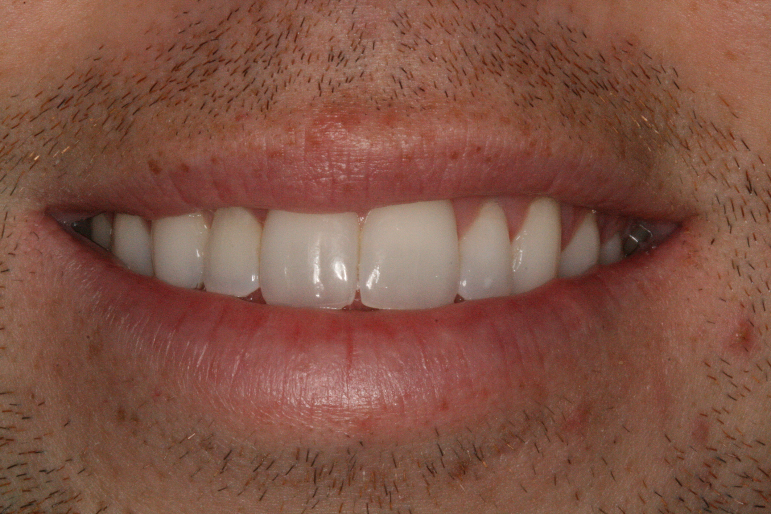 The Tuddenham Road Dental Surgery - Six_Month_Smiles6.JPG