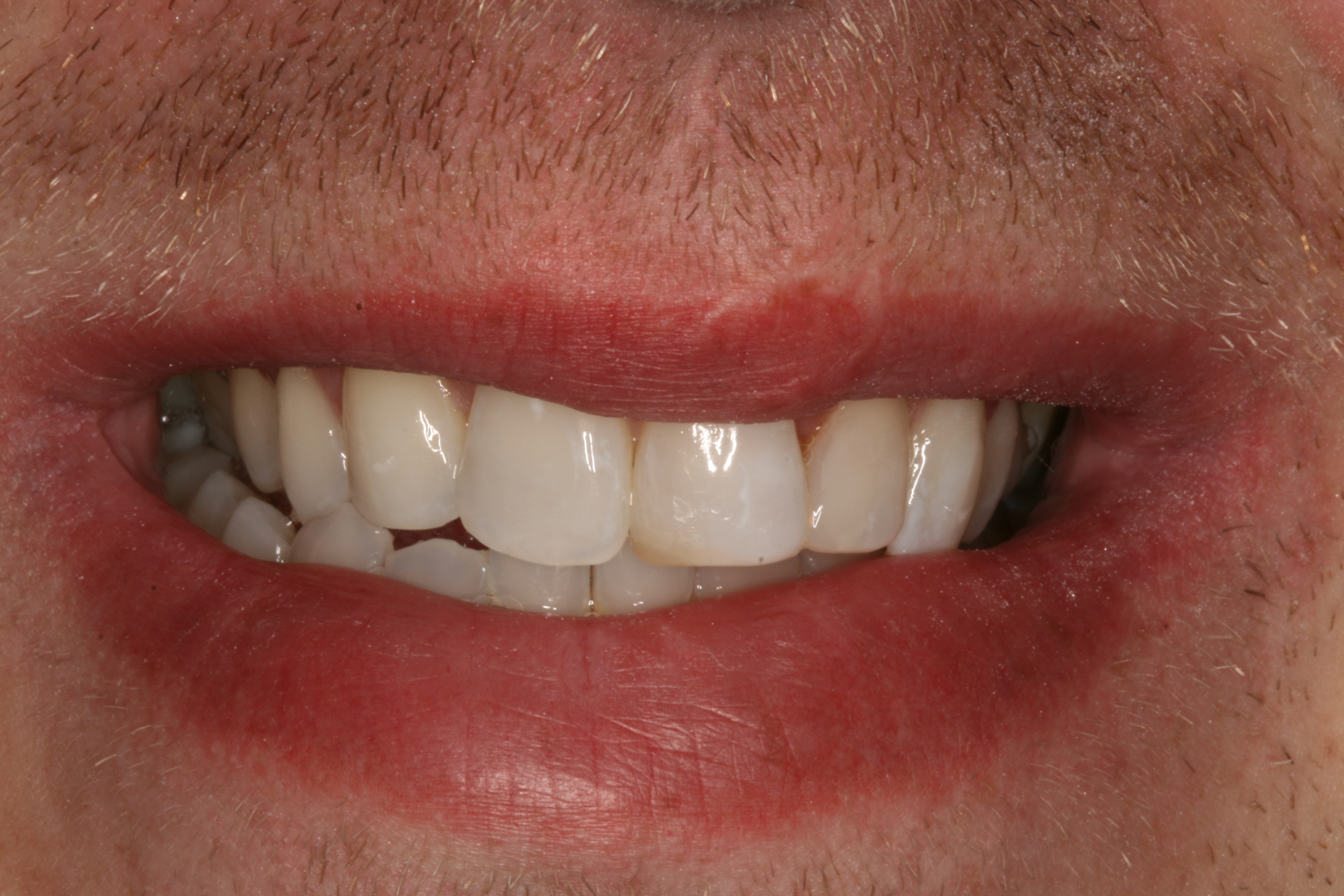 The Tuddenham Road Dental Surgery - Six_Month_Smilesa4.JPG