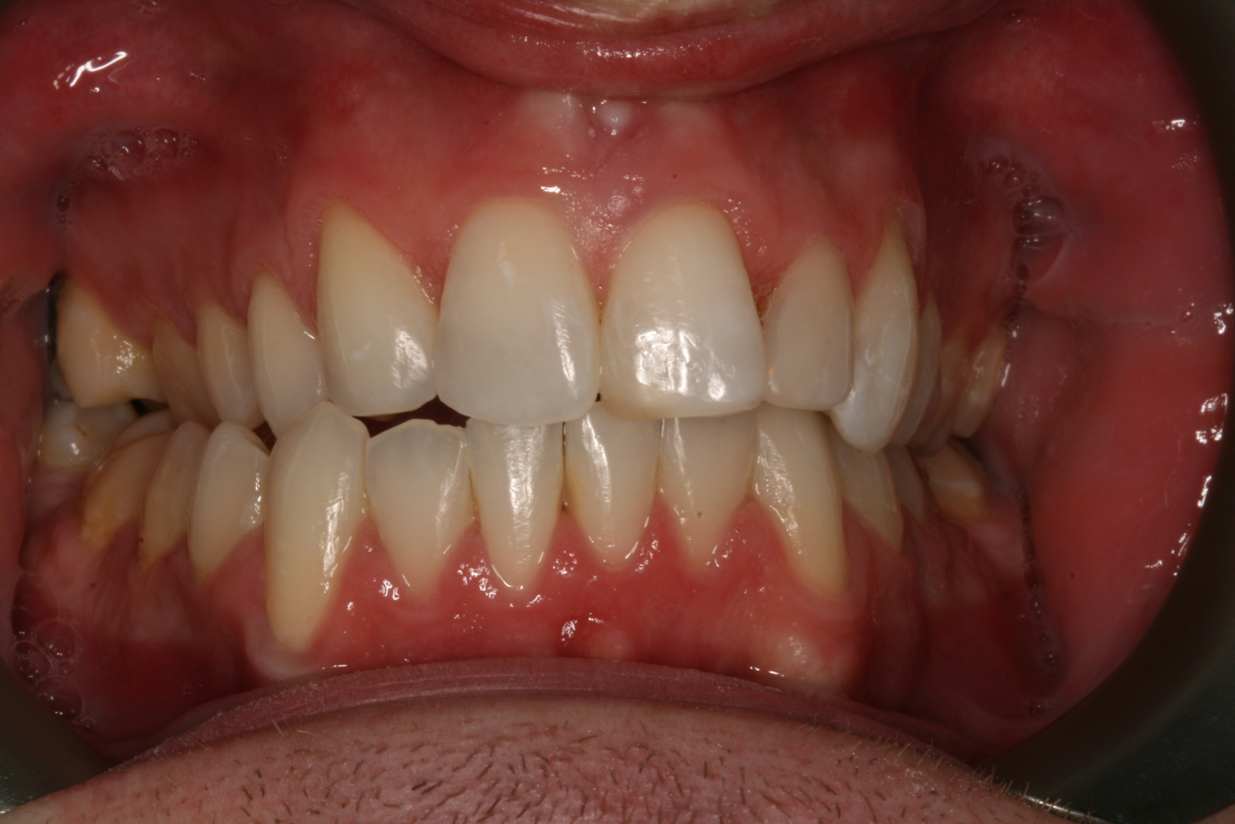 The Tuddenham Road Dental Surgery - Six_Month_Smilesa5.JPG