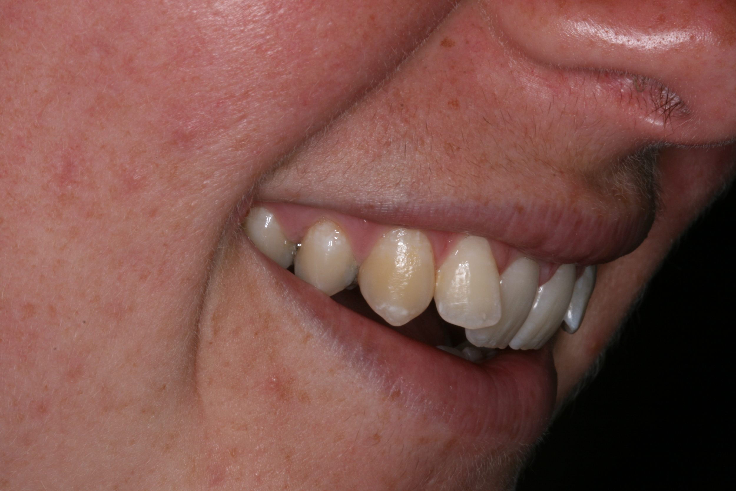 The_Tuddenham_Road_Dental_Surgery_Clear_Aligners5.JPG