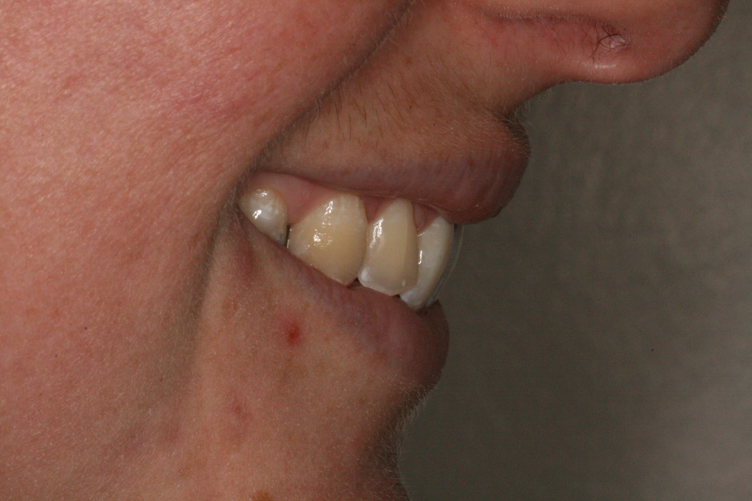 The_Tuddenham_Road_Dental_Surgery_Clear_Aligners4.JPG