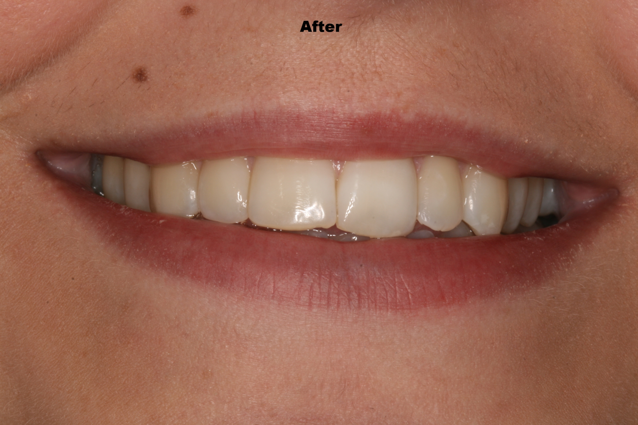 The Tuddenham Road Dental Surgery - Six_Month_Smiles2.JPG