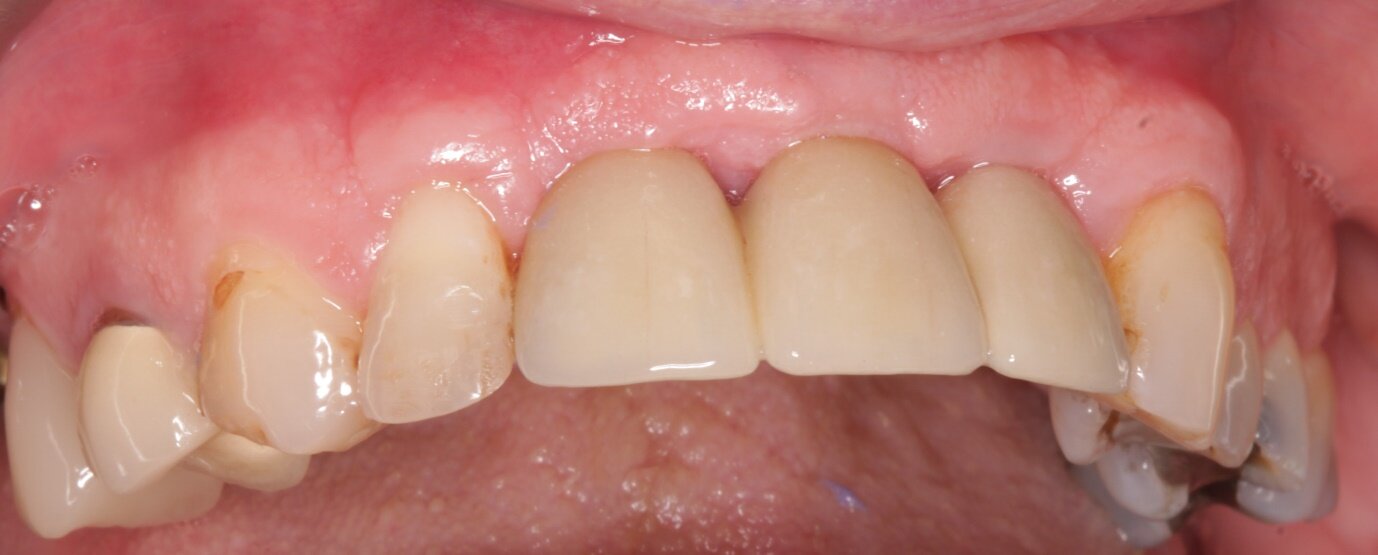 implant pic 5web.jpg