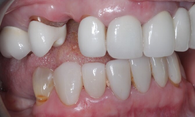 implant pic 7web.jpg