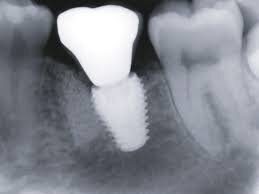 implant x-ray image.jpg