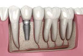 implant image.jpg