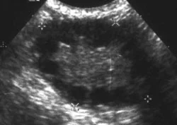 PCOS-delayed-diagnosis.jpg