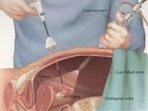 Laparoscopic ovarian surgery to treat endometriosis, adhesions, ovarian cysts hydrosalpinx and ectopic pregnancy.
