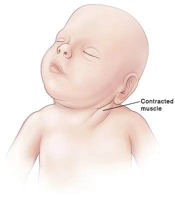 baby birth torticollis.jpg
