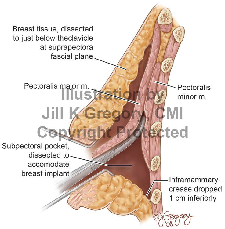 Surgical Approach: Breast Augmentation