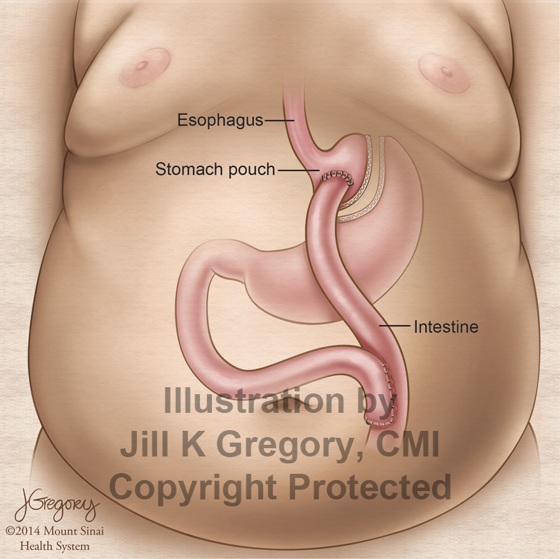 Patient Education: Roux-en-Y bypass