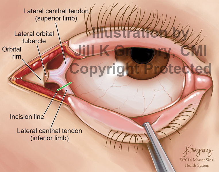 Approach to Eye Socket