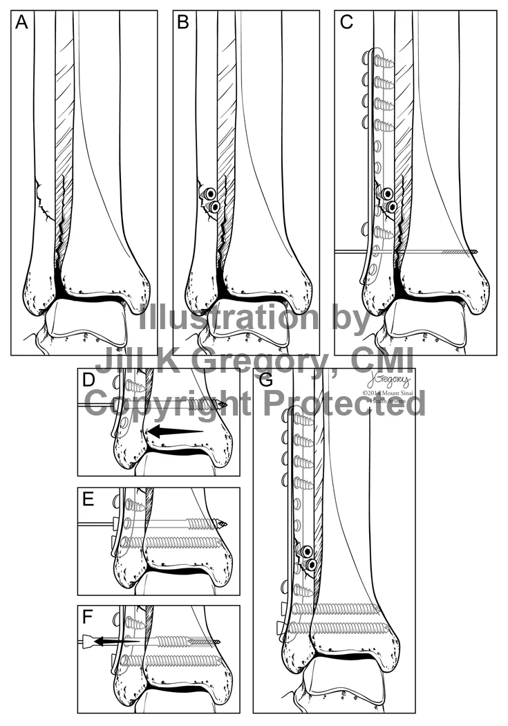 Repair of Tibia-Fibular Fracture
