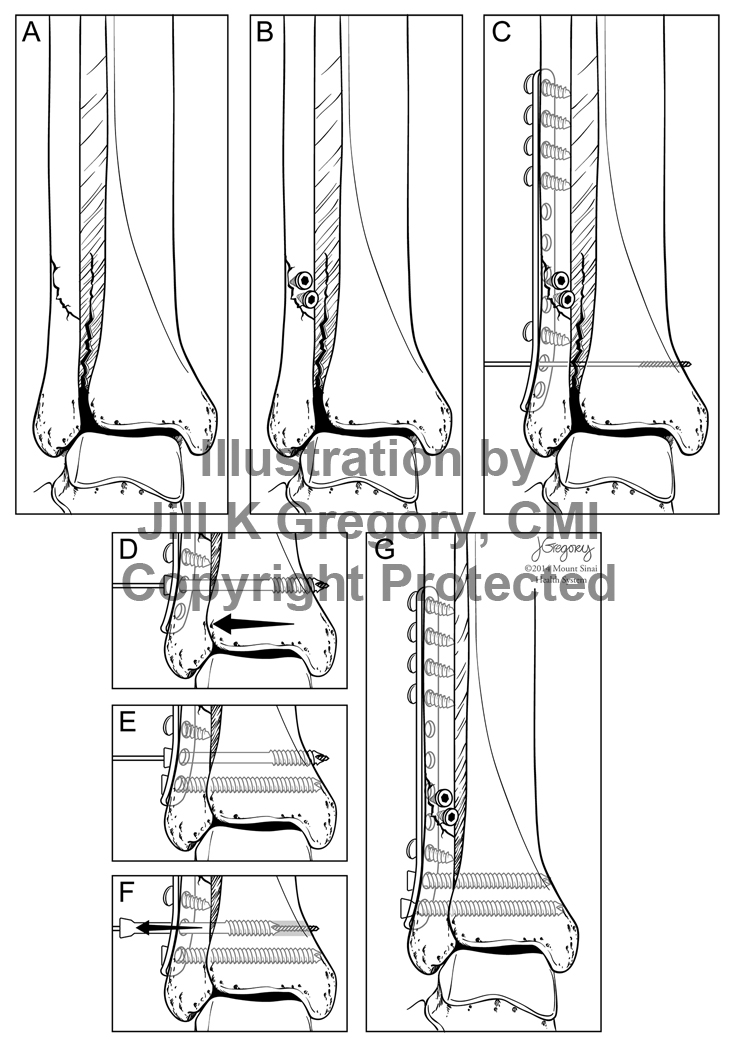 Repair of Tibia-Fibular Fracture