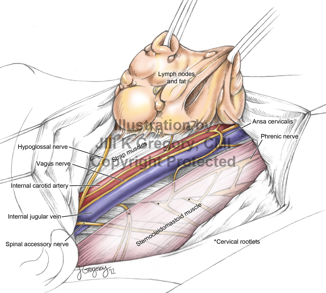 Removal of Neck Lymph Nodes