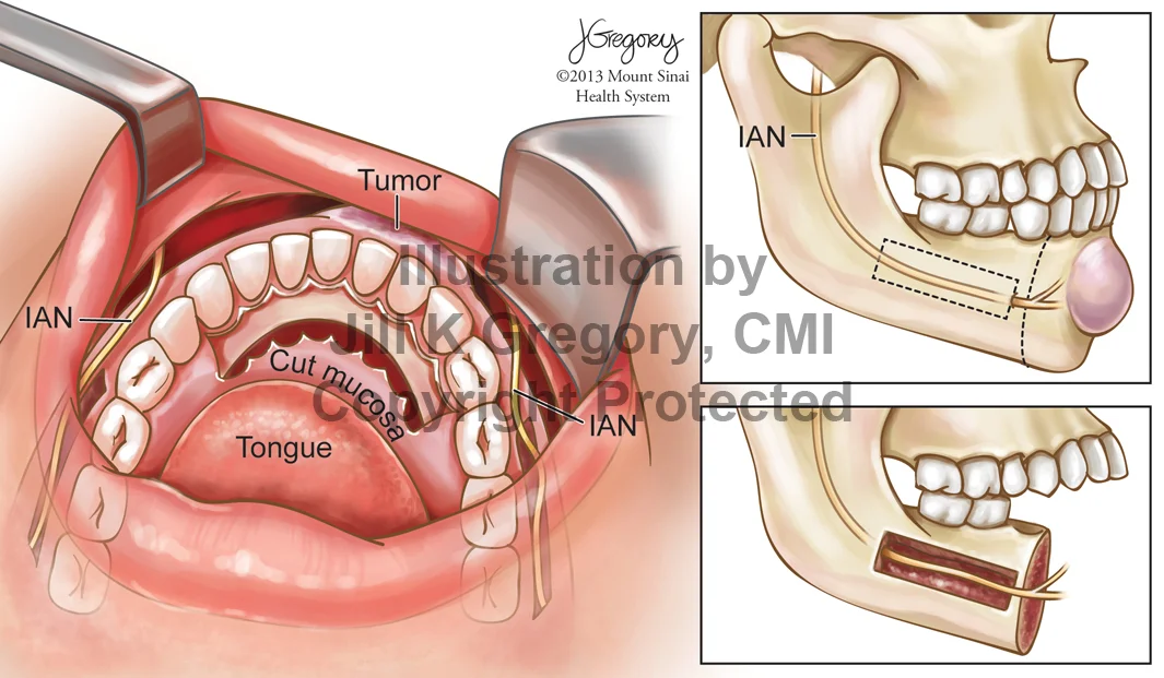 Surgical Approach to Mandibular Tumor, Sparing the Alveolar Nerve