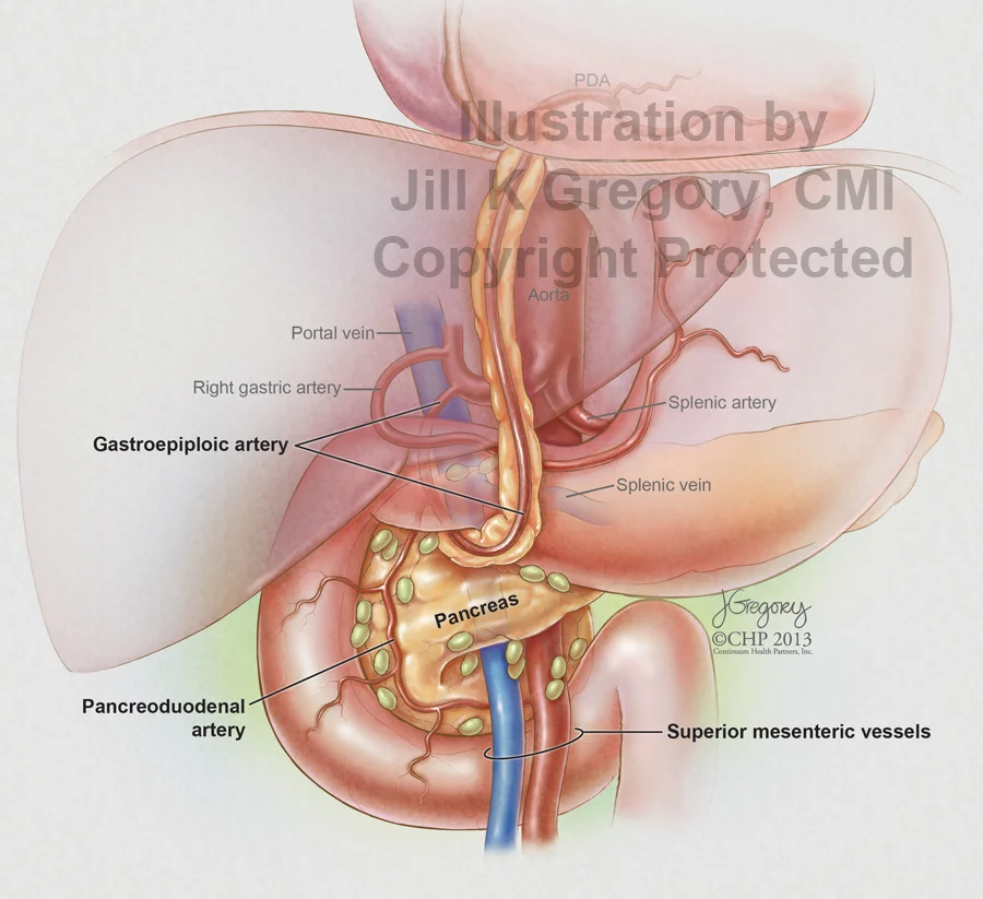 Pancreatic Lymph Nodes and Gastroepiploic Bypass