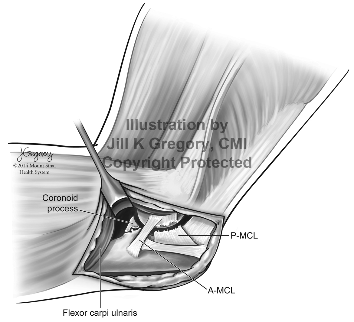 Exposure of Coronoid Process Fracture in the Elbow