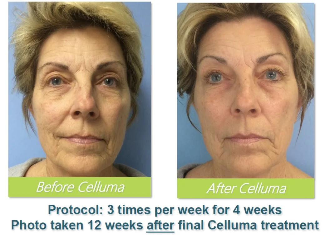 Before-and-After-Led-Light-Therapy-Celluma-Tampa-4.jpg