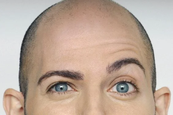 Could Researchers Have Discovered a Cure for Baldness?