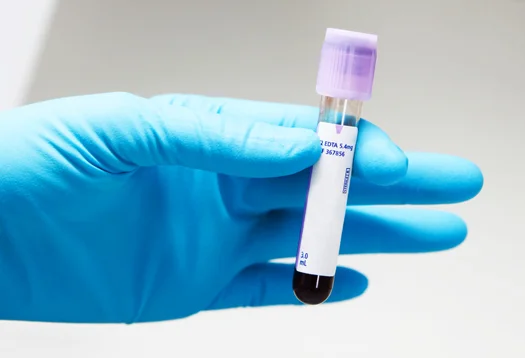 PSA After Prostatectomy – What Patients Should Know