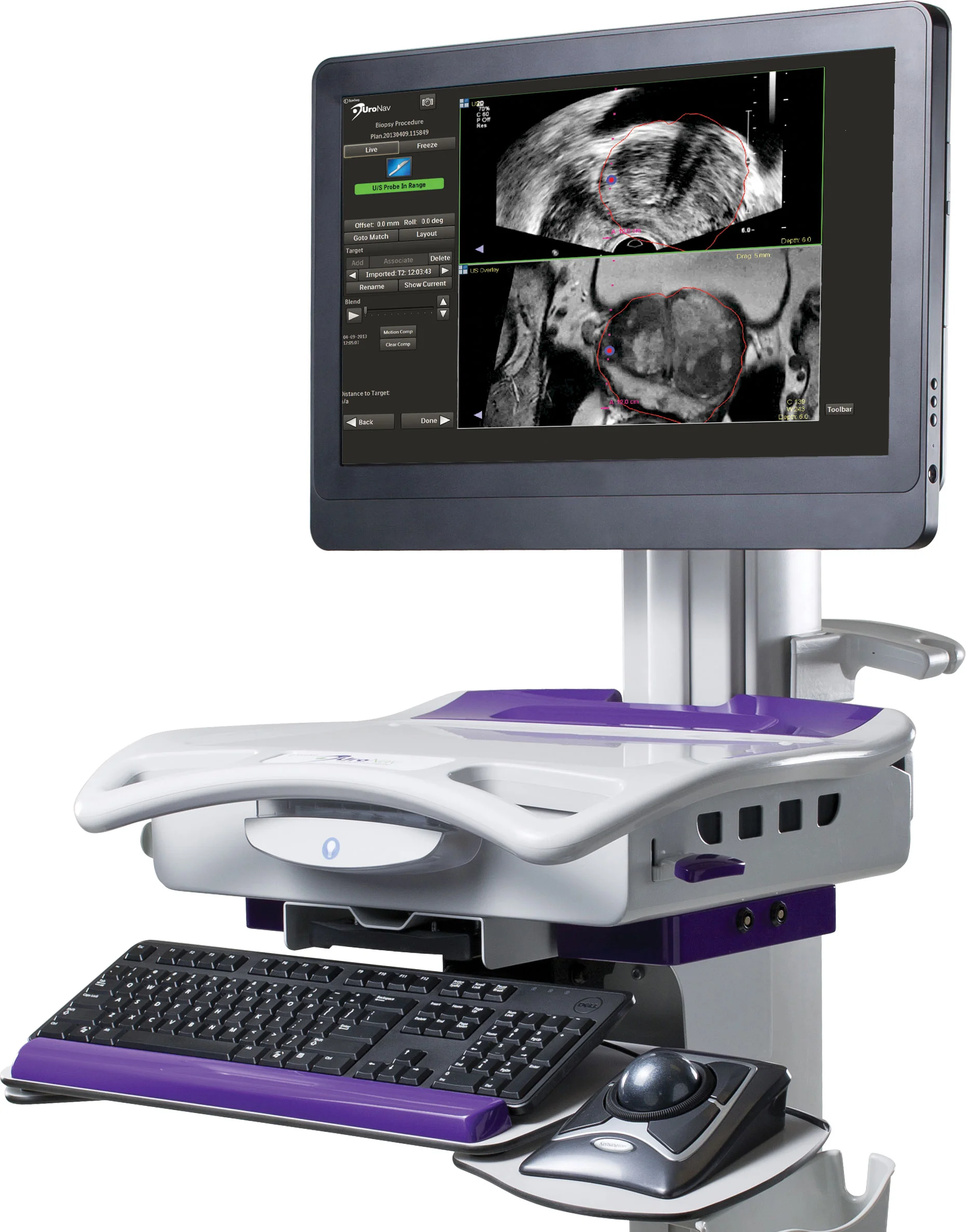 MRI Fusion Guided Prostate Biopsy