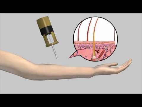 Scientists develop device for needle-less injection