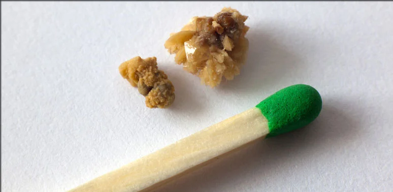 How to prevent kidney stones