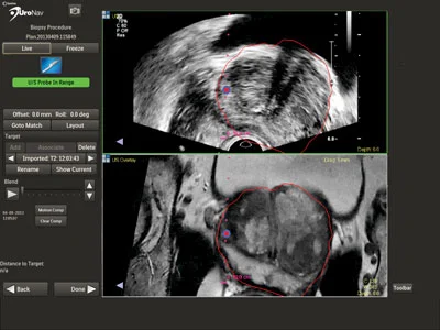 MRI-Guided Biopsy: Better Detection Method for Prostate Cancer