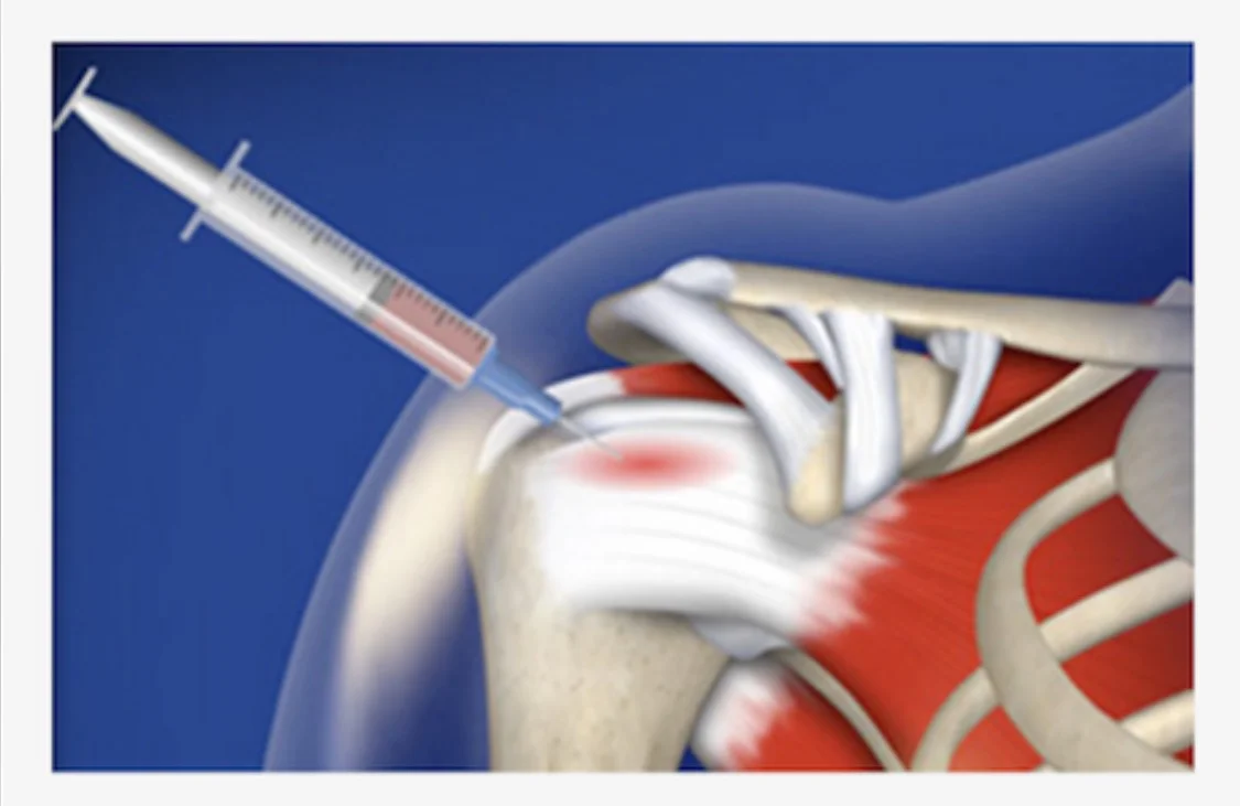 Plasma Injections: Do or Don't?