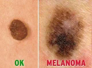 Utah Researchers May Have Found Melanoma Cure