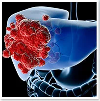 The Deadliest Cancers