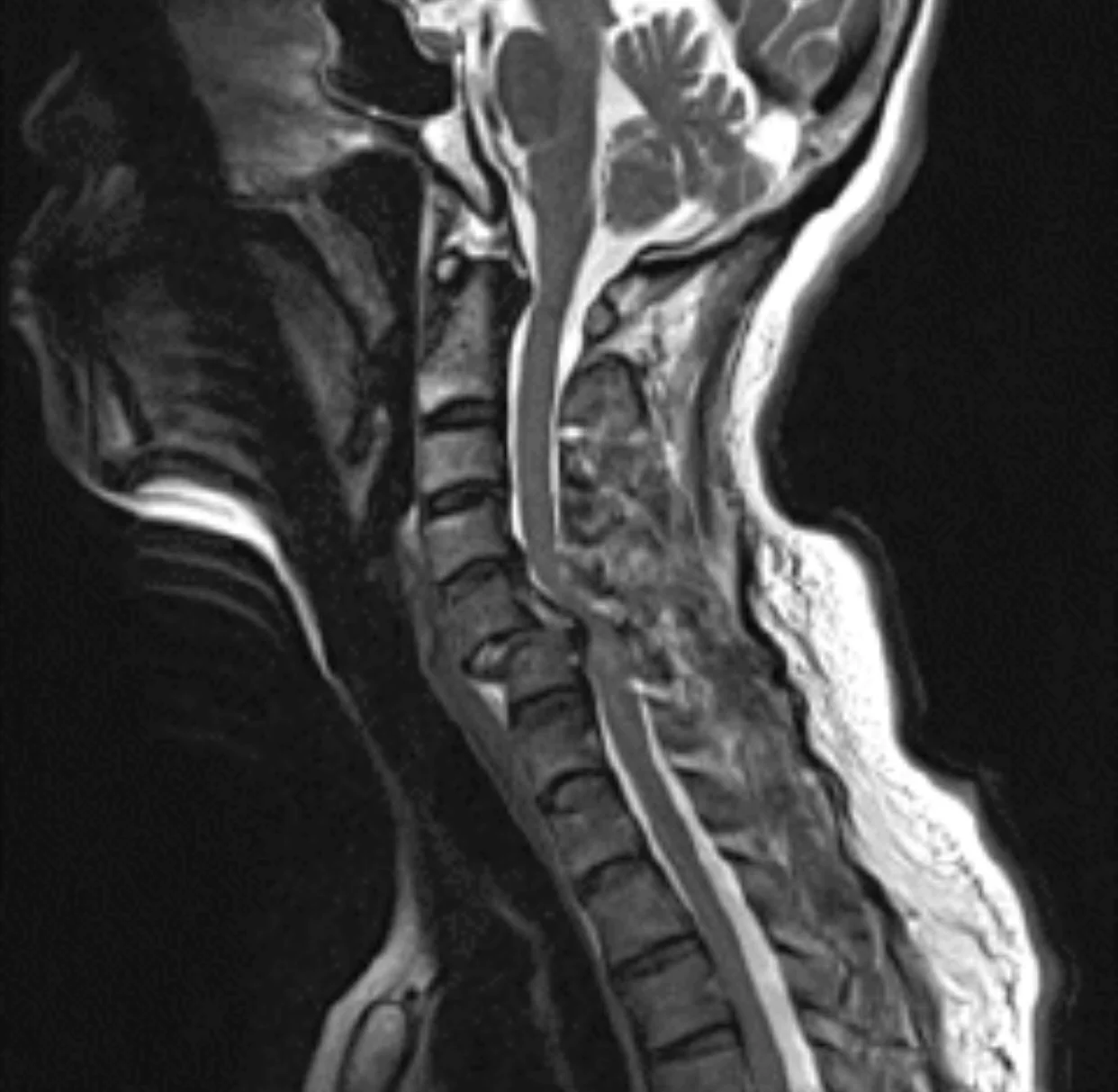 How does a spinal cord injury happen?