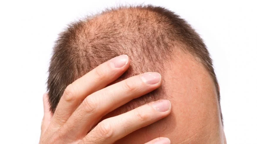 Baldness May Increase Prostate Cancer Risk