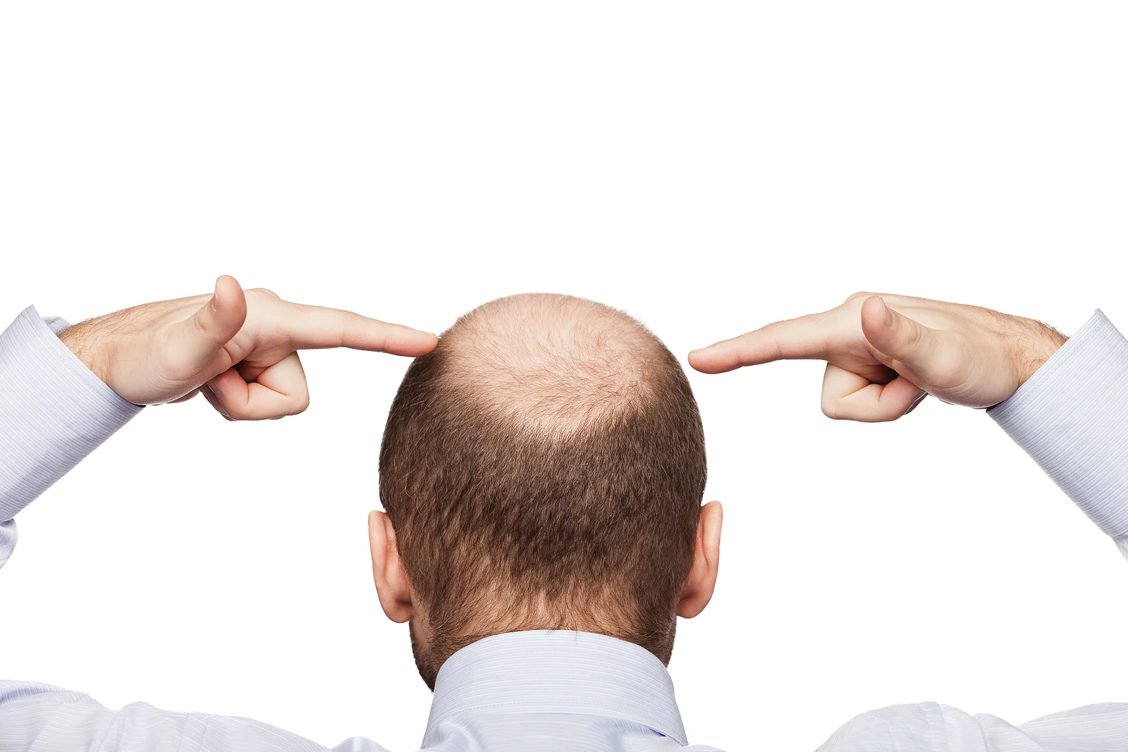baldnessprostatecancer.jpg