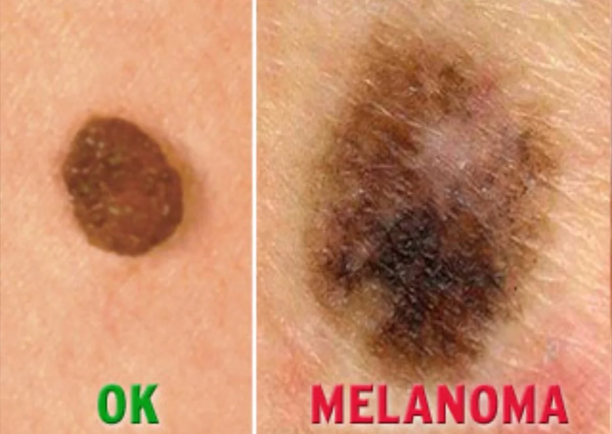 Types of Melanoma
