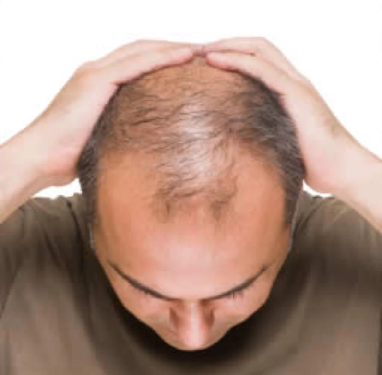 Is baldness linked to prostate cancer?