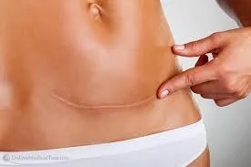 New screening method detects ovarian cancer in twice as many women