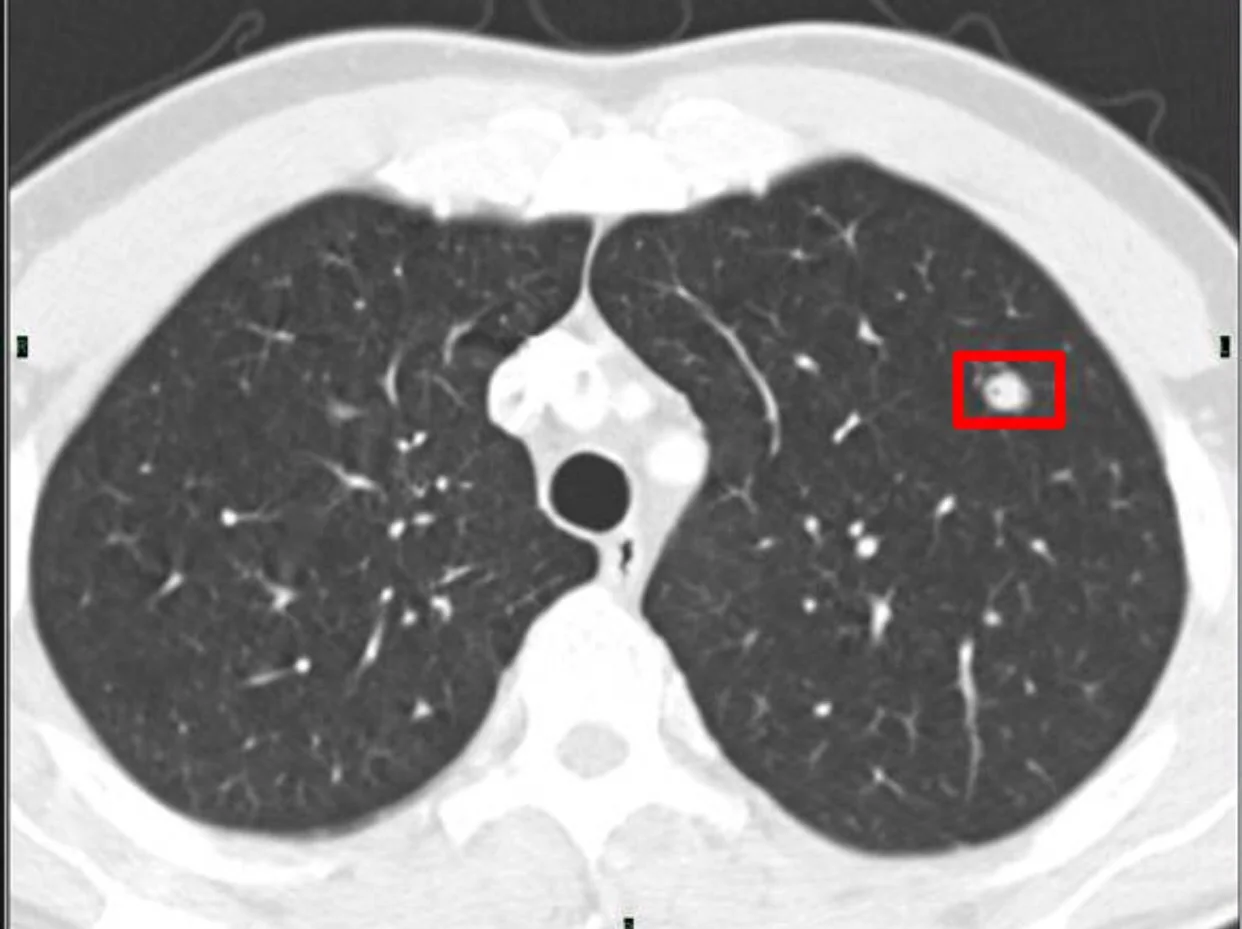 Medicare will pay for Lung CT Scans