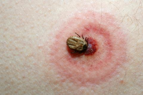 Tick season is coming: Prevent Lyme disease