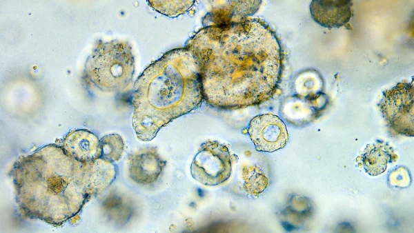 Mini-guts Grown from Colon Cancer Spark New Treatment Hopes 