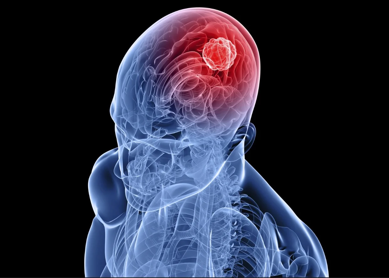 Learning about Brain Tumors