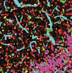 New technology identifies brain tumor types