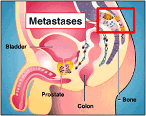 Chemo Hormonal Therapy and Surgery for Metastatic Prostate Cancer