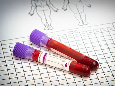 AUA disagrees with USPSTF prostate cancer screening recommendation