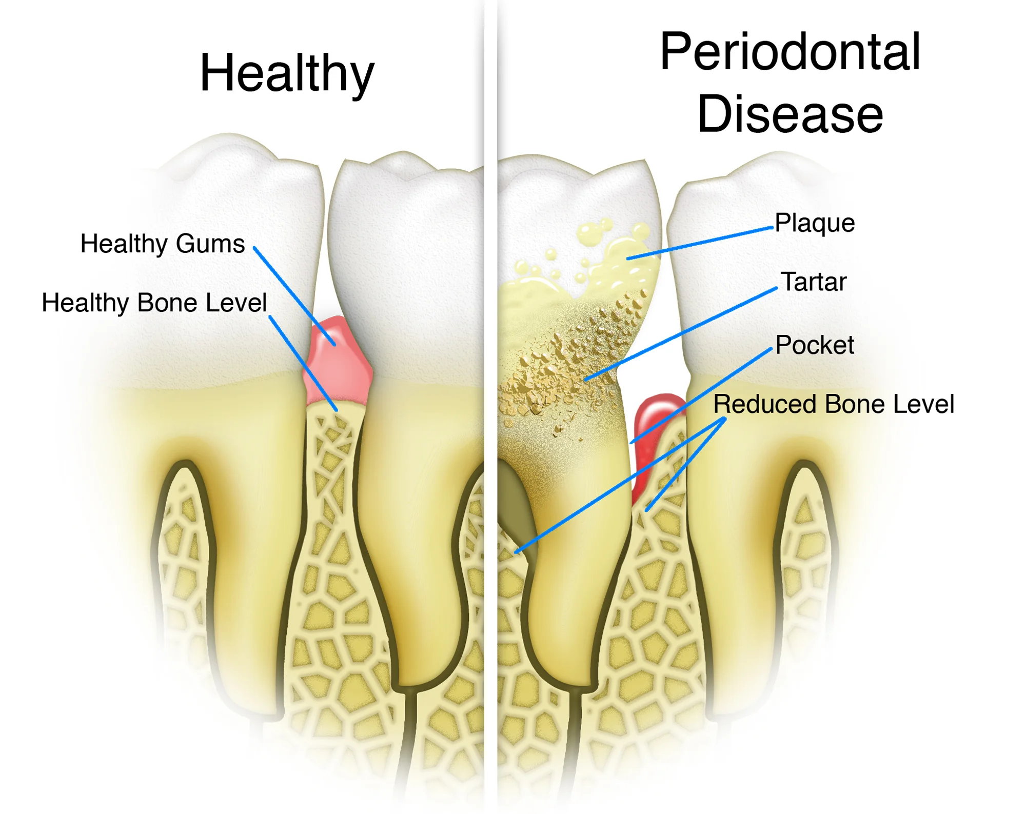 Study: Prostate symptoms reduced by treating gum disease