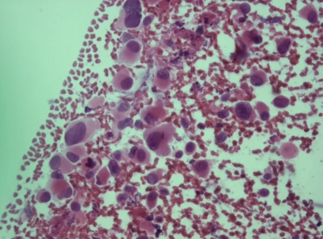 Pancreatic Cancer: What You Need to Know