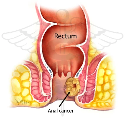 Facts about anal cancer