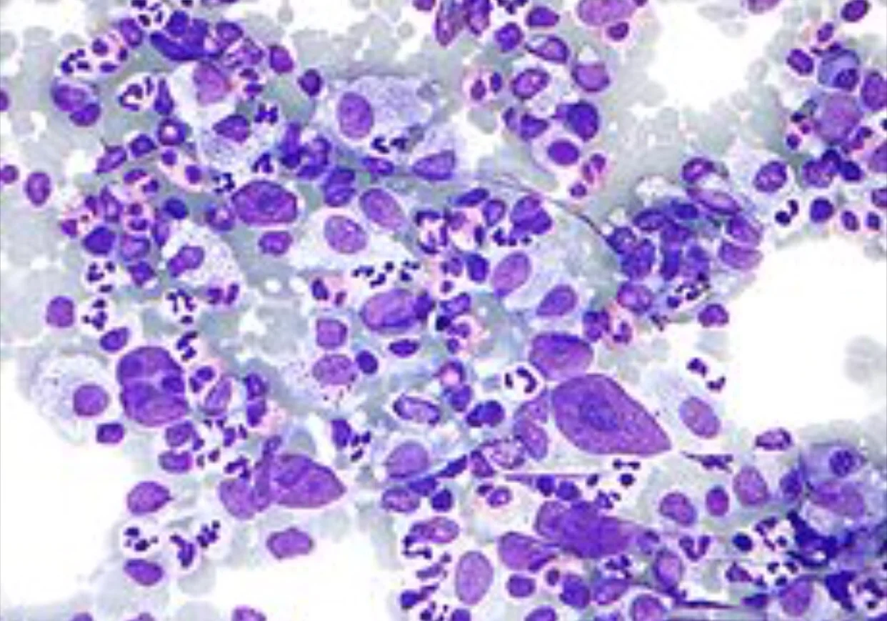 Hodgkin disease: A type of lymphoma